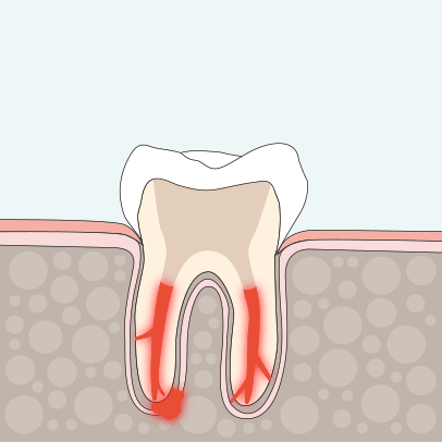 Zahnarzt Ising Endodontie 1