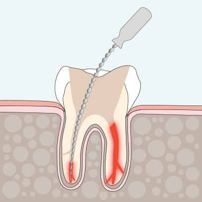 Zahnarzt Ising Endodontie 2