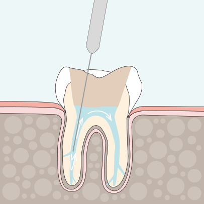 Zahnarzt Ising Endodontie 3