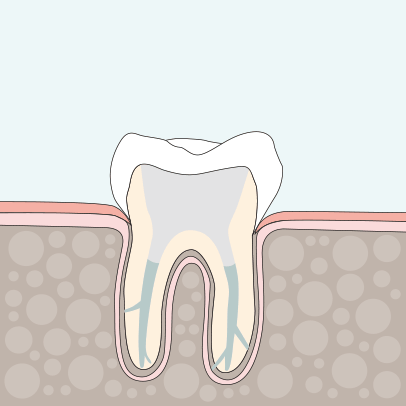 Zahnarzt Ising Endodontie 4