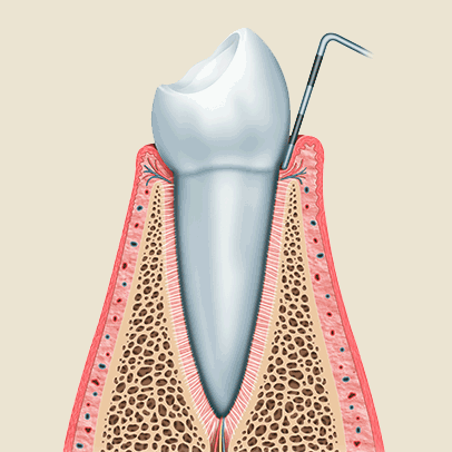 Zahnarzt Ising Parodontologie 1