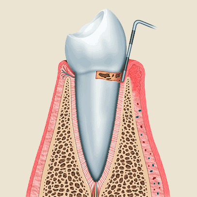 Zahnarzt Ising Parodontologie 2
