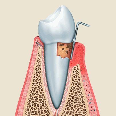 Zahnarzt Ising Parodontologie 3