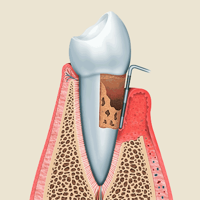 Zahnarzt Ising Parodontologie 4